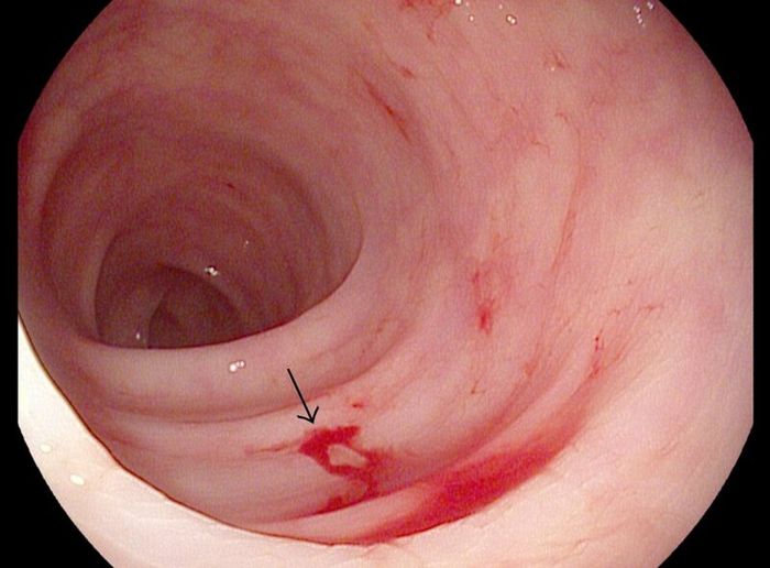 Hãy cẩn thận khi phát hiện tiêu chảy có màu đỏ do xuất huyết từ đường tiêu hóa