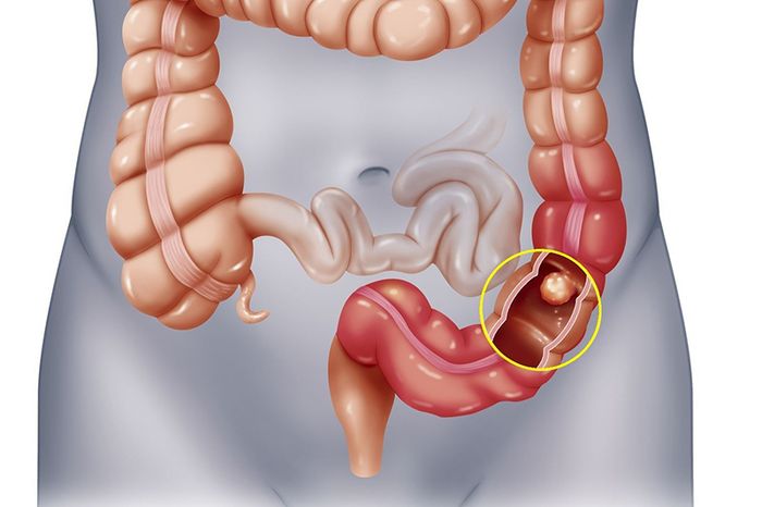 Ung thư trực tràng là biến chứng nguy hiểm của bệnh trĩ