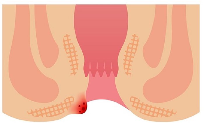 Dấu hiệu của bệnh trĩ ngoại là khi búi trĩ bị tụt ra ở mép hậu môn