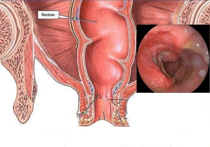 Kiểm tra đại tràng bằng nội soi để phát hiện tổn thương.