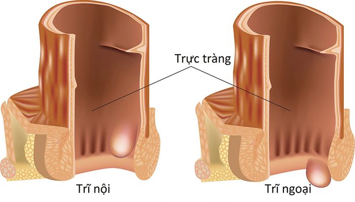 Trĩ nội (hình bên trái) và trĩ ngoại (hình bên phải) là hai dạng trĩ phổ biến và có những triệu chứng khá tương đồng