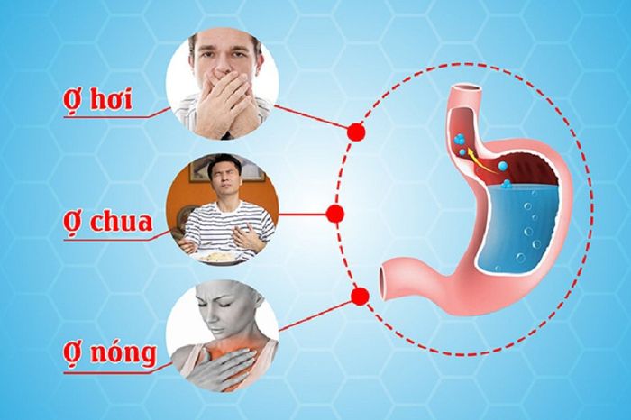 Triệu chứng phổ biến ở người mắc bệnh trào ngược dạ dày