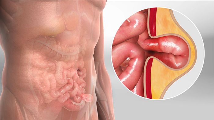 Thoát vị bẹn ẩn mang theo nguy cơ nghiêm trọng của những biến chứng nguy hiểm.