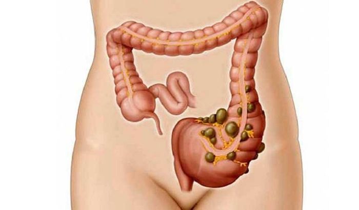 Viêm ruột dạ dày đại tràng thường phát sinh sau khi đại tràng bị viêm nhiễm