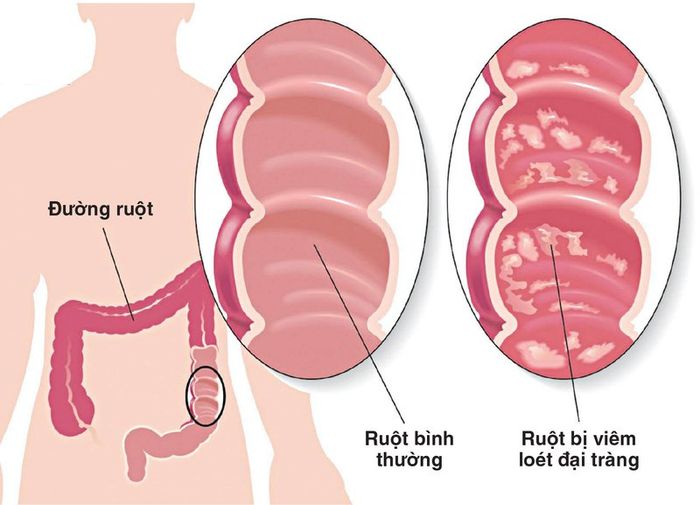 Viêm loét đại tràng là một trong những nguyên nhân gây ra sự tăng nhu động của nhu động ruột chủ