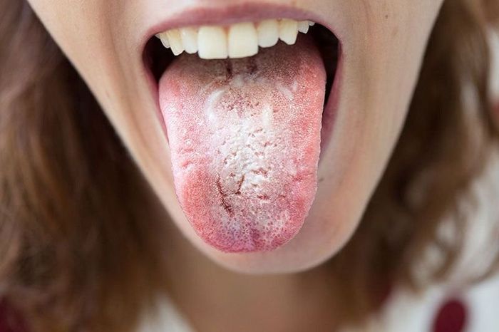 Nấm miệng là bệnh lý khoang miệng do trào ngược dạ dày, thường gặp ở nhiều người.