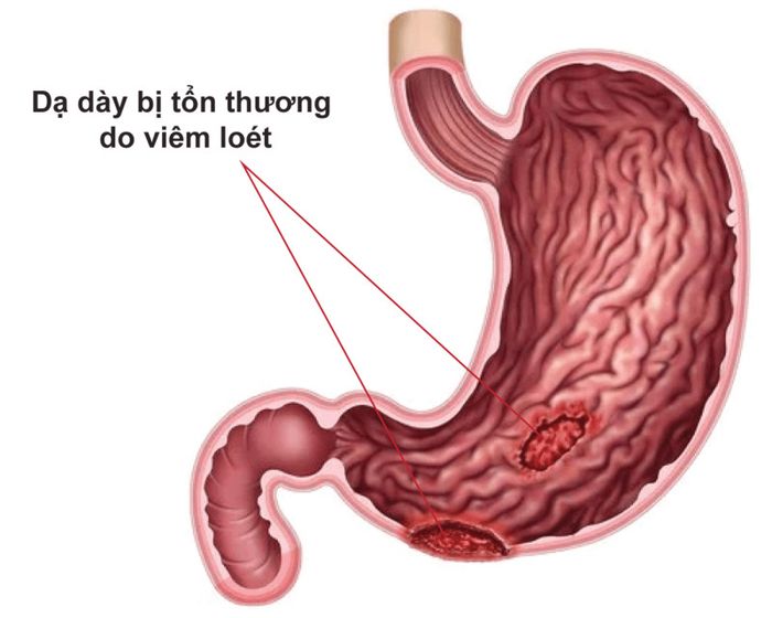 Viêm loét dạ dày tá tràng là một trong những nguyên nhân phổ biến gây đau dạ dày