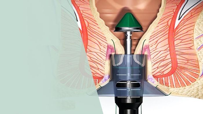 PPH là một phương pháp điều trị trĩ được coi là hiệu quả nhất hiện nay