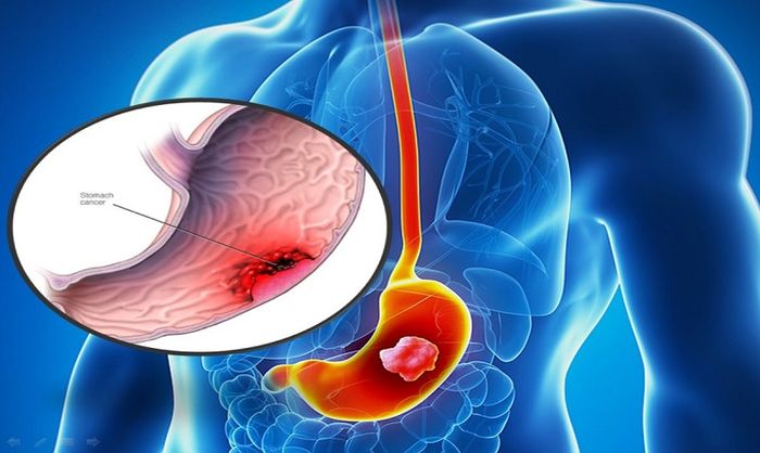 Ung thư dạ dày là bệnh lý nghiêm trọng nhất của dạ dày