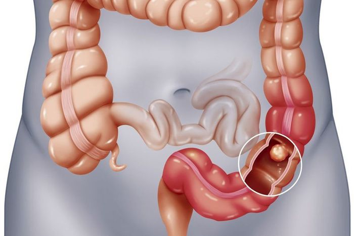 Quy Trình Khi Thực Hiện Nội Soi Đại Tràng