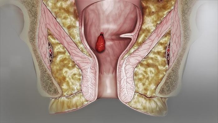 Chi phí phẫu thuật trị trĩ thay đổi tùy theo từng trường hợp và mức độ bệnh lý.