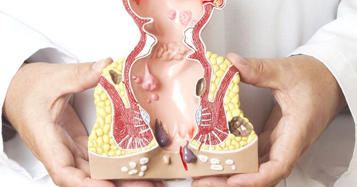 Ngày nay, có nhiều phương pháp cắt búi trĩ hiện đại