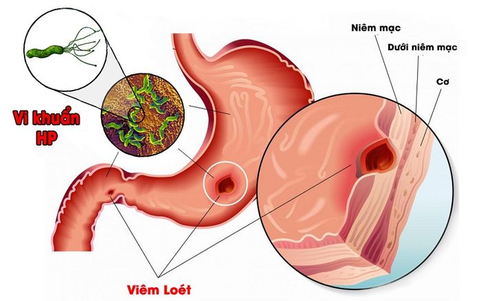 Có nhiều bệnh dạ dày phổ biến