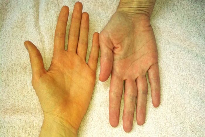 da vàng là dấu hiệu của bệnh gì?