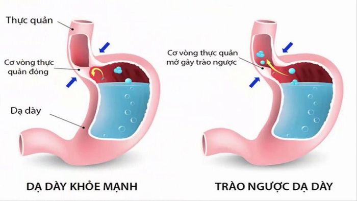 Triệu chứng và điều trị viêm thực quản trào ngược