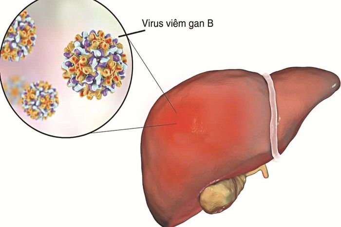 Bệnh viêm gan B là một trong những nguyên nhân gây ra tình trạng vàng da
