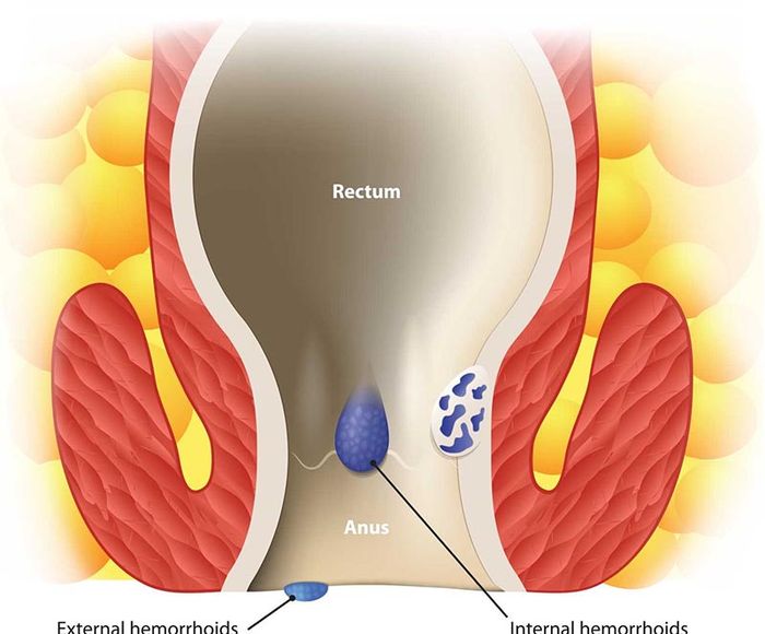 Bệnh trĩ có ảnh hưởng đến sinh sản không?