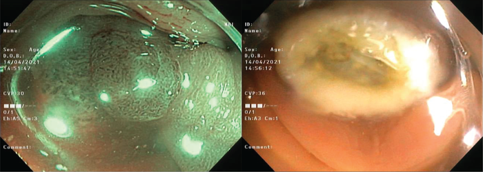 Hình ảnh polyp đại tràng phát hiện bằng ánh sáng dải tần hẹp (NBI) và hình ảnh cắt polyp qua nội soi bằng snare (ảnh theo thứ tự từ trái qua phải)