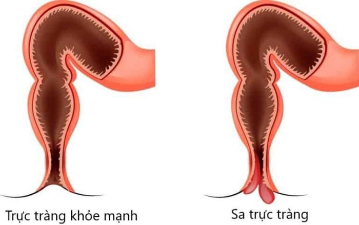 Sa trực tràng là hậu quả của táo bón kéo dài