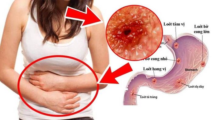 Viêm loét dạ dày cũng là một trong những nguyên nhân gây ra khoảng 10 - 20% trường hợp xuất huyết từ dạ dày