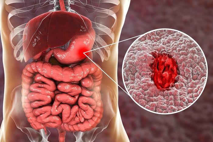 nguyên nhân gây ra việc xuất huyết dạ dày