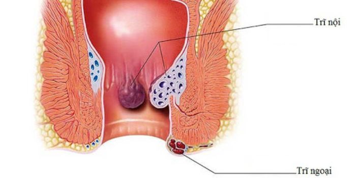 Táo bón là nguyên nhân hàng đầu gây ra bệnh trĩ