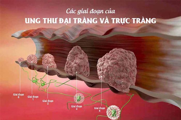 Các khối u bên trong đại tràng có thể gây đau ở bụng