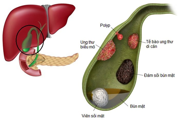 Polyp túi mật có kích thước lớn là nguyên nhân cần phải loại bỏ túi mật