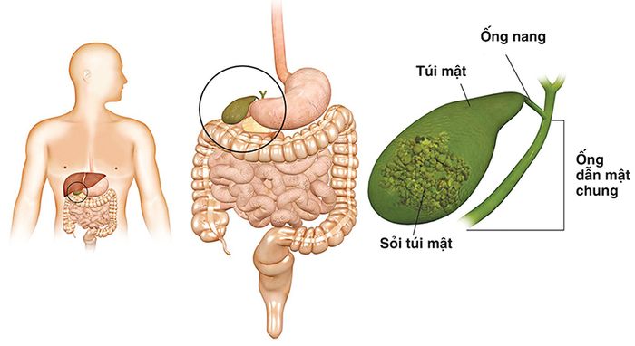 Sỏi Túi Mật - Vấn Đề Phổ Biến Ngày Nay