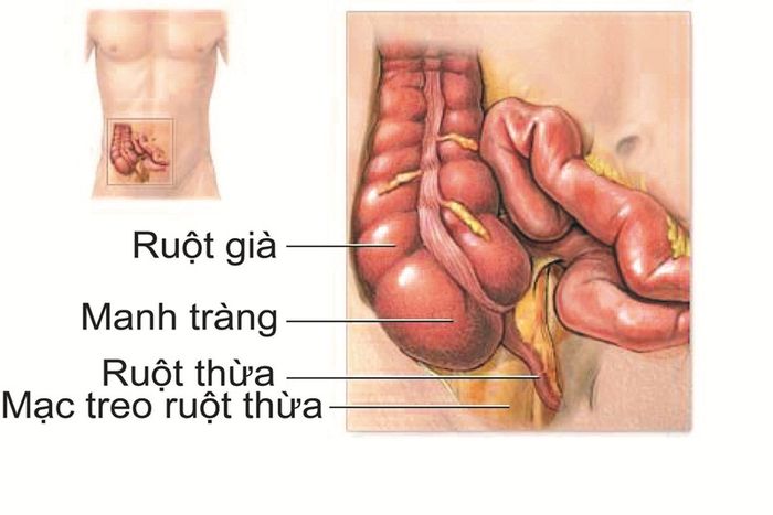 viêm ruột thừa có cần phẫu thuật không