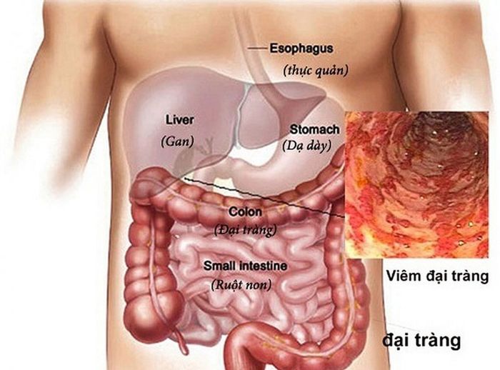 Nguyên nhân dẫn đến đau đại tràng