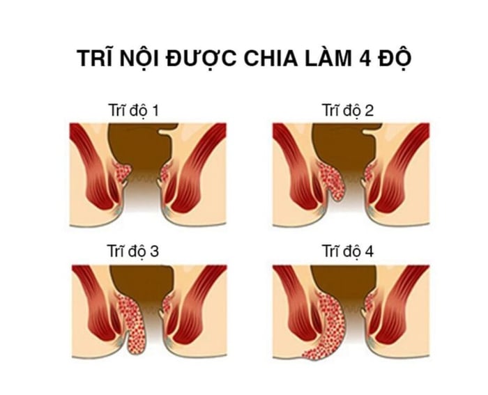 Dấu hiệu của trĩ giai đoạn 4