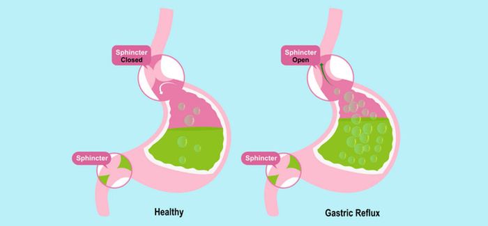 Sự suy yếu của cơ thắt dưới thực quản khiến axit dạ dày trào ngược lên trên.