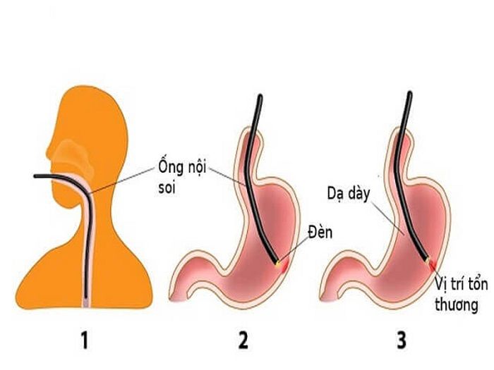 Quy trình nội soi dạ dày