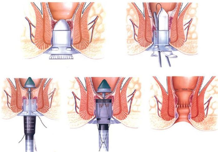 Điều trị dứt điểm trĩ bằng Longo - Không đau đớn