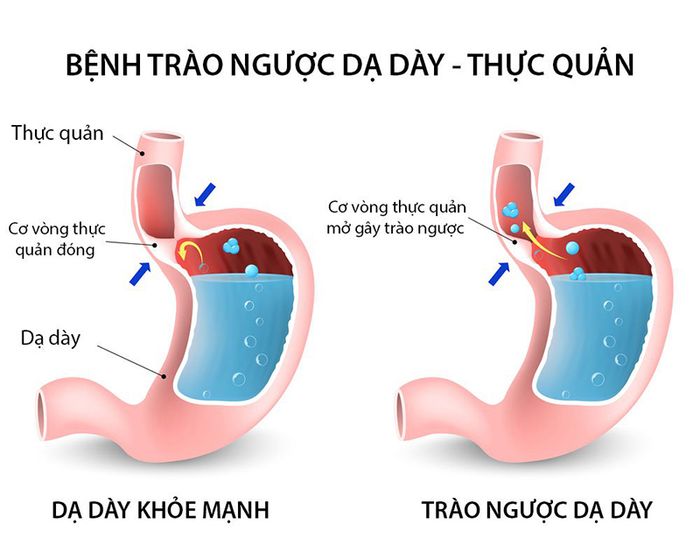 trào ngược dạ dày gây khó thở