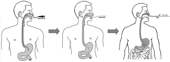 Nội soi thông qua mũi giúp bệnh nhân giảm cảm giác khó chịu, buồn nôn so với nội soi qua miệng.