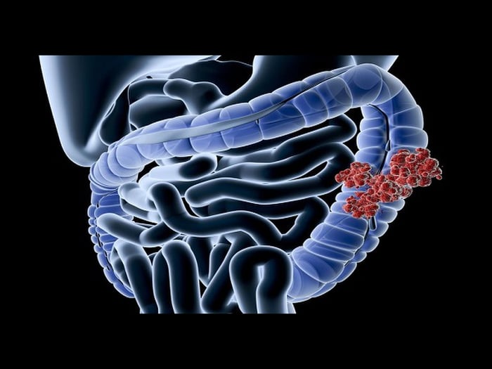 nguyên nhân gây ra bệnh viêm ruột Crohn đặc trưng bởi tình trạng viêm ruột từng phần