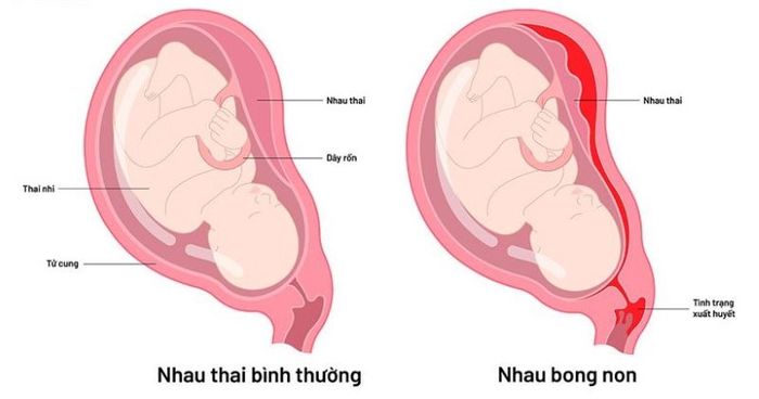 Mẹ bầu ở tuần thứ 39 cảm thấy đau bụng dưới có thể do sự bong nhau non.