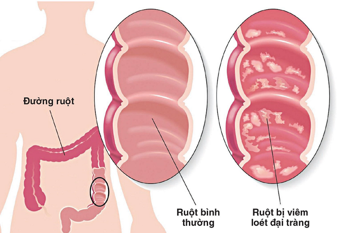 Khi bị viêm đại tràng, ruột sẽ xuất hiện các vết loét, tạo điều kiện thuận lợi cho vi khuẩn có hại phát triển