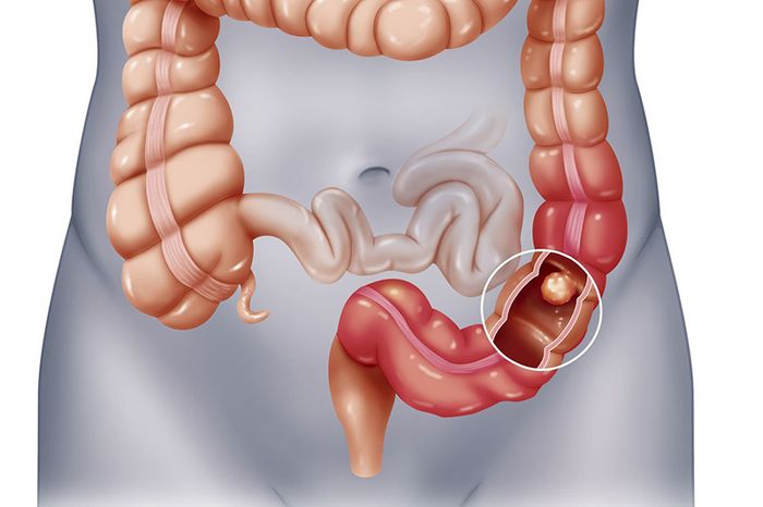 Cuộc sống không lành mạnh dẫn đến sự xâm nhập của các vật có tính sát thương như vật nhọn, hạt nhỏ, hạt cứng trái cây,... vào hệ tiêu hóa có thể gây tổn thương cho phần ruột thừa, gây viêm nhiễm.