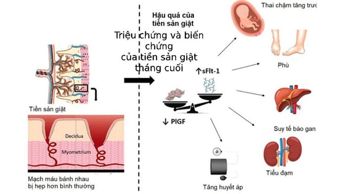 Tổng quan về hội chứng tiền sản giật