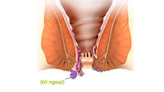 Bệnh trĩ chảy máu: mối lo ngại