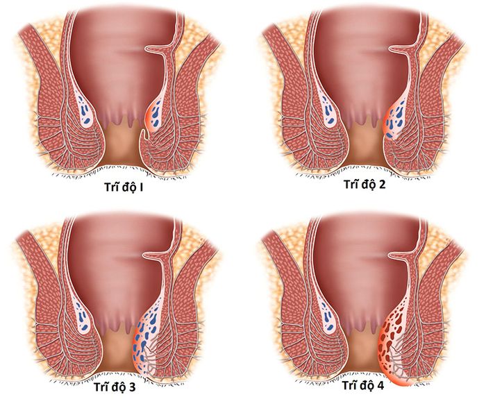 Các giai đoạn phát triển của bệnh trĩ