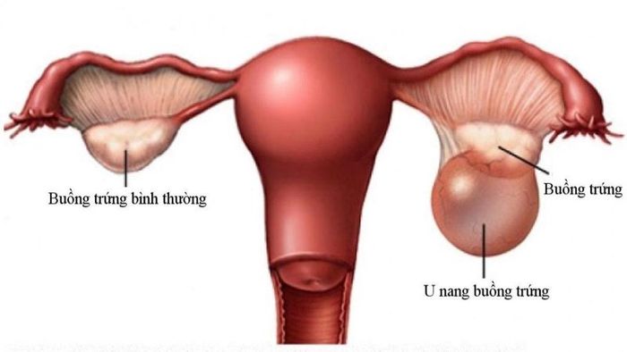 Nang đơn thùy buồng trứng là một loại u nang phát triển trong buồng trứng