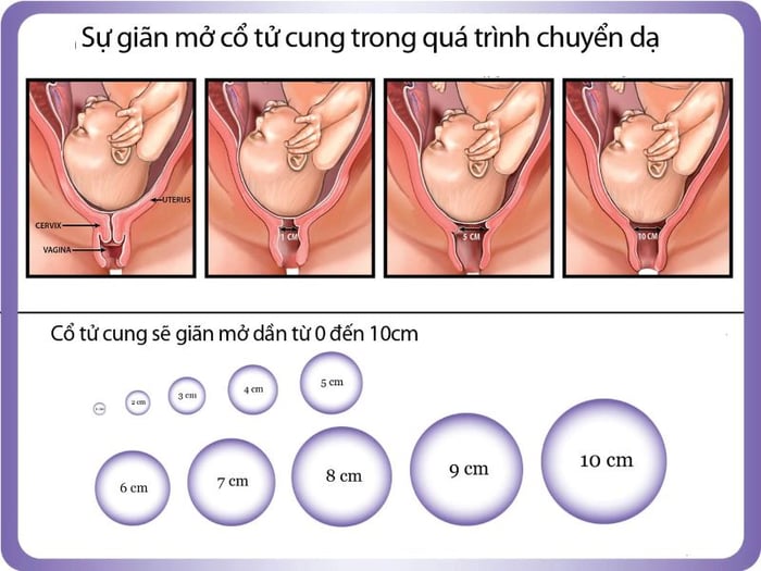 Quá trình mở rộng cổ tử cung khi chuyển dạ