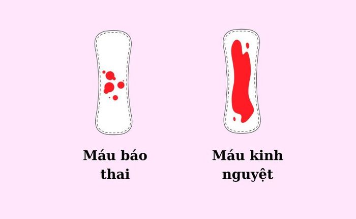 Máu báo thai thường ra dưới dạng nhỏ giọt, lấm tấm và cần phải phân biệt với máu kinh