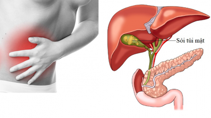 Sỏi túi mật có thể gây đau ở phần bụng bên trái hoặc vùng thượng vị