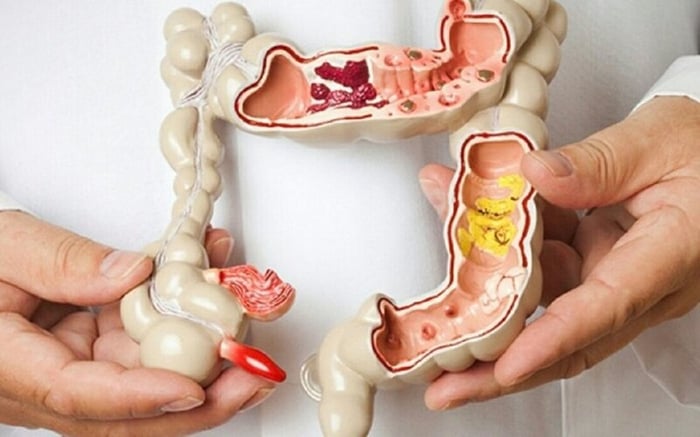 Đa số polyp đại tràng lành tính.