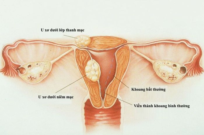 Các cục u có thể phát triển trong cổ tử cung do u xơ